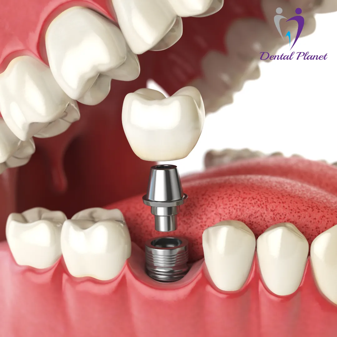 Permanent Teeth Replacement